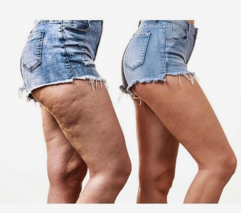 Cathaleya Vacuum Turbo 300 ist die ideale Lösung bei Übergewicht, Cellulite, Wasserüberschuss im Körper und bei müden und schweren Beinen