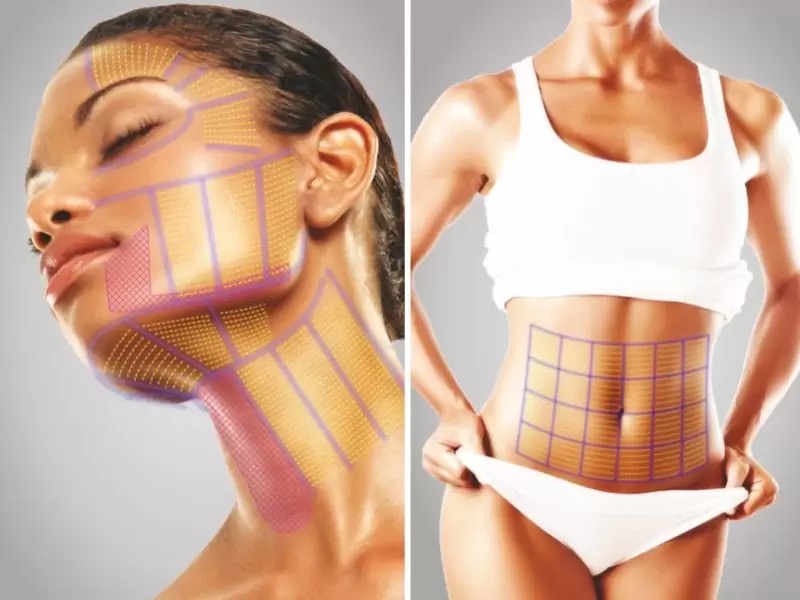 HIFU-Behandlung ( HIFU Hoch Intensiver Fokussierter Ultraschall ) ist eine moderne und nicht-operative Anti-Aging-Methode, bei der Sie, ganz ohne Ausfallzeiten, nach der Behandlung direkt wieder Ihrem Alltag nachgehen können.