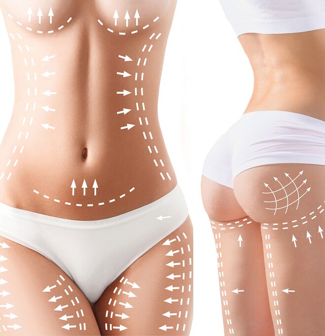 Cellulite Behandlung