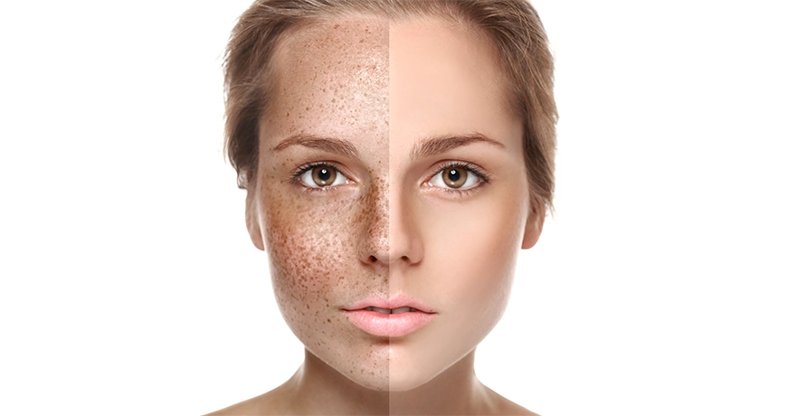 Pigmentflecken Entfernen auf den Oberlippe Pigmentflecken Entfernen auf den Oberlippe